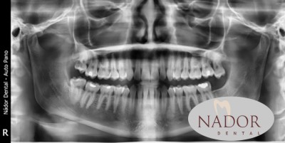 Miért kell röntgen egy fogászati kezeléshez?